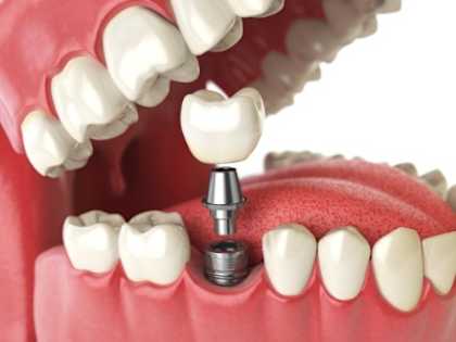Here's What Full Mouth Dental Implants Should Cost