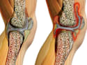 Bone on Bone Joints? Try This 15 Second Solution
